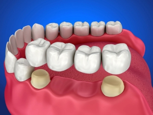 How do dental crowns work