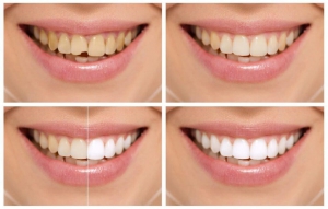 When is dental bonding recommended?
