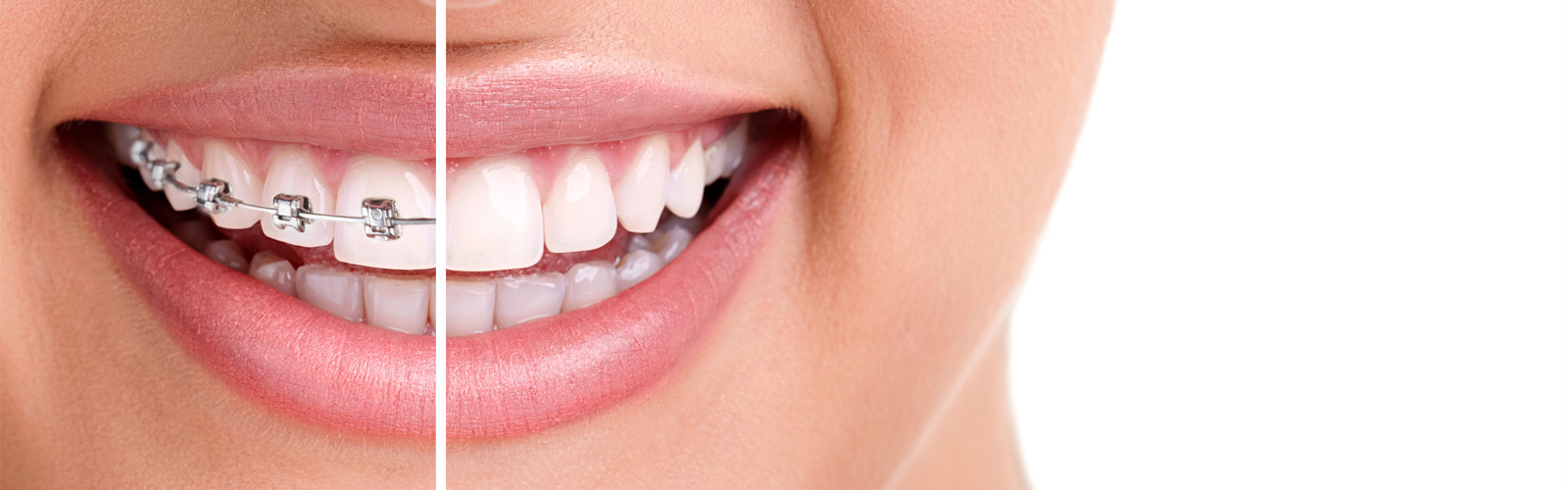 What Is The Best Age To Get Braces On Your Teeth?