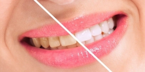 Are There Any Side Effects from Teeth Whitening?