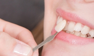 Benefits of dental veneers