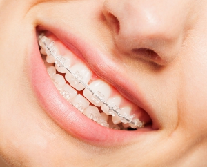 CERAMIC BRACES