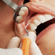 Dental Bonding: What is Teeth Bonding & What to Expect
