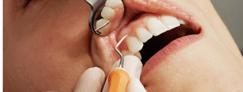 Dental Bonding: What is Teeth Bonding & What to Expect