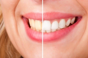 How Does Teeth Whitening Work?