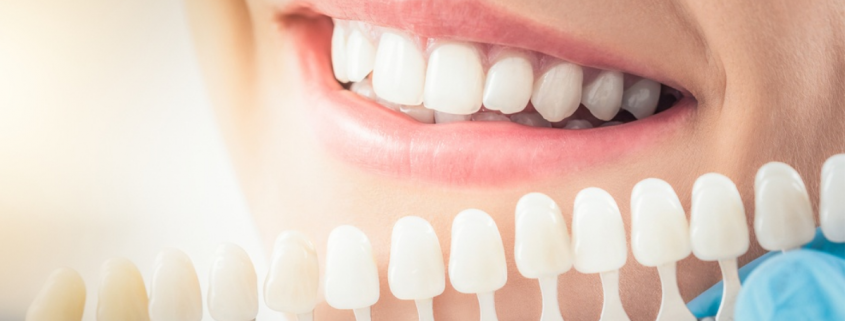 Teeth Whitening: Things to Know About Getting a Brighter Smile
