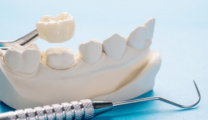 The different types of dental crowns