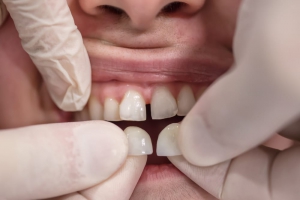 What are the different types of veneers?