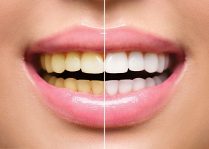 Types of Teeth Whitening